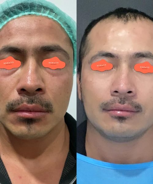 Antes y despues ojeras en Guatemala